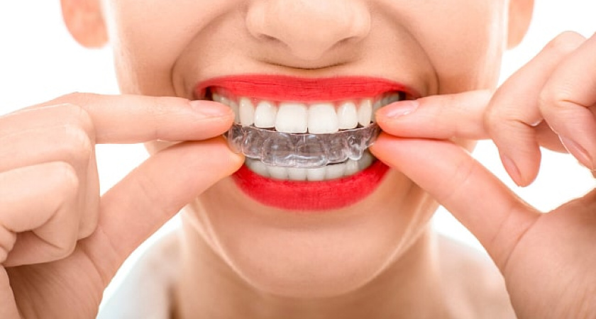 Профессиональная установка брекетов в Казани: качество и результат