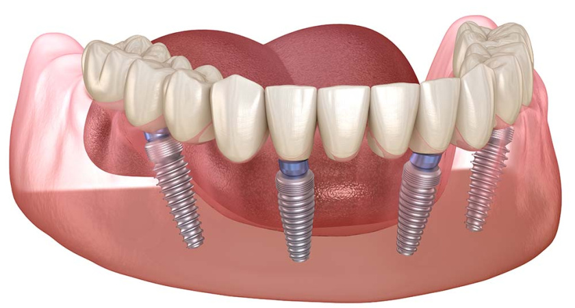 Преимущества имплантации зубов: Почему стоит выбрать этот метод для восстановления зубного ряда