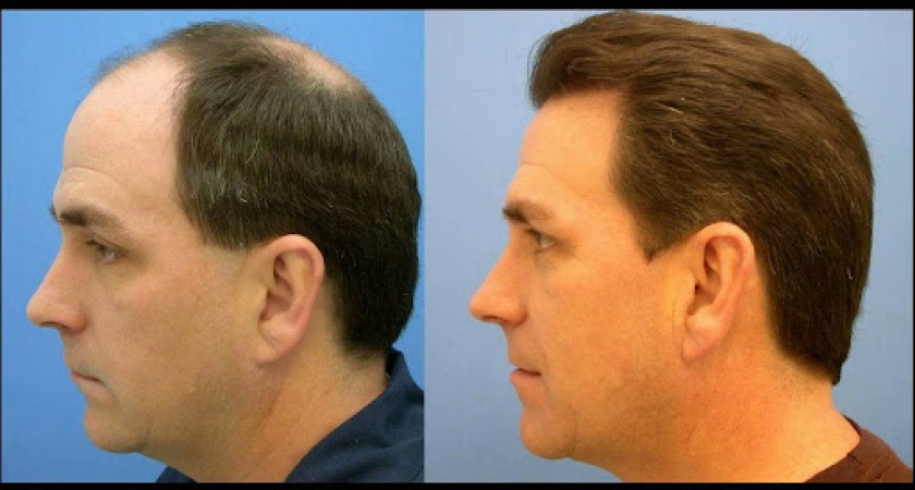 Трансплантация волос в клинике GGraft.ru – инновационные методы пересадки