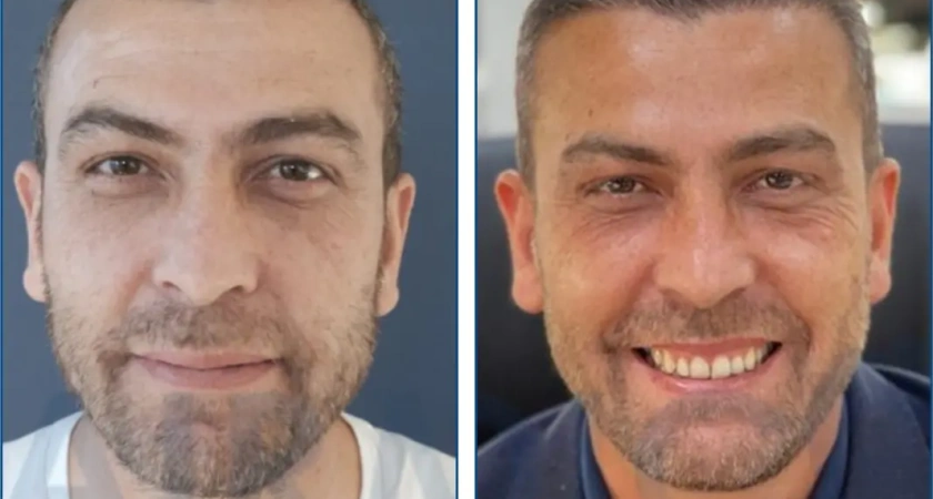 Пересадка волос: современное решение проблемы облысения