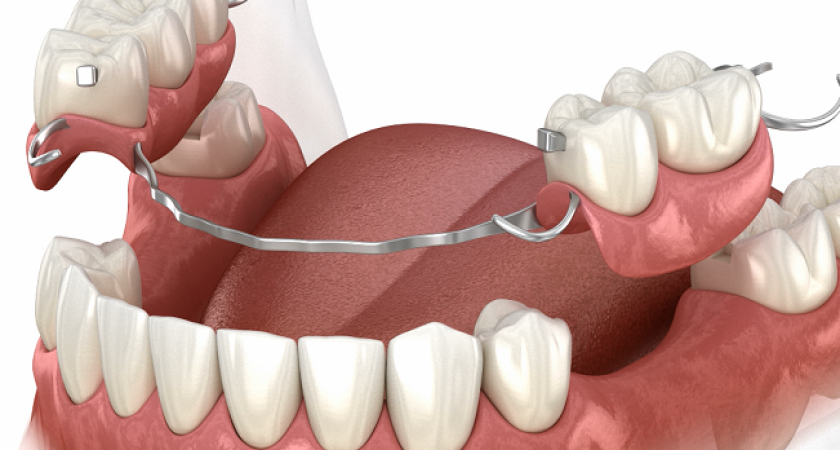 Преимущества частично-съемного протезирования зубов: когда и почему стоит выбрать этот метод